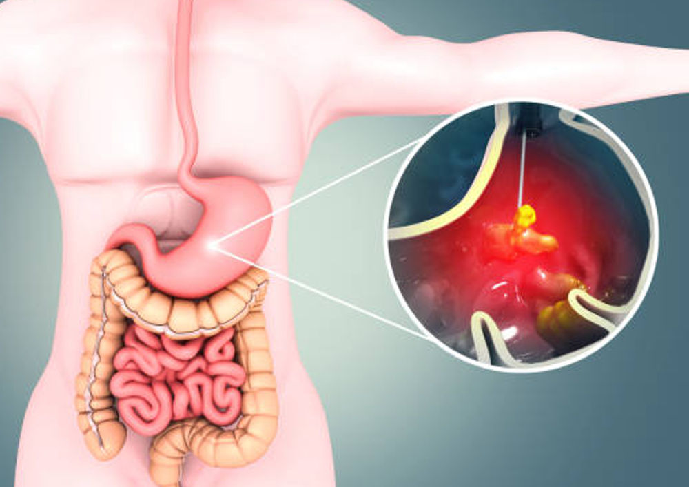 cayenne-pepper-could-help-stomach-ulcers-acudetox-academy-online