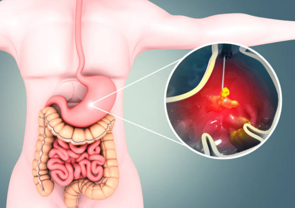 Cayenne Pepper Could Help Stomach Ulcers Acudetox Academy Online